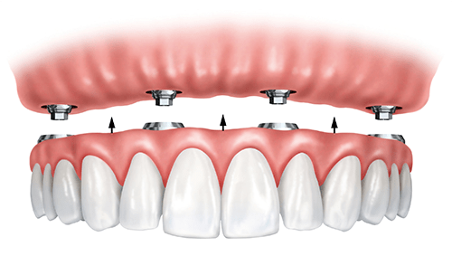 Example of All-On-4® Dental Implants