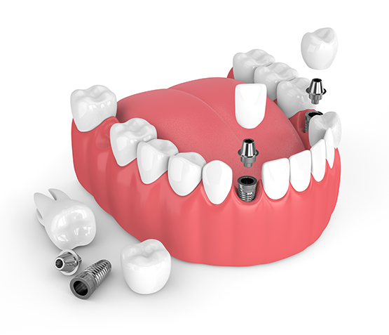 Dental Implants Merrillville